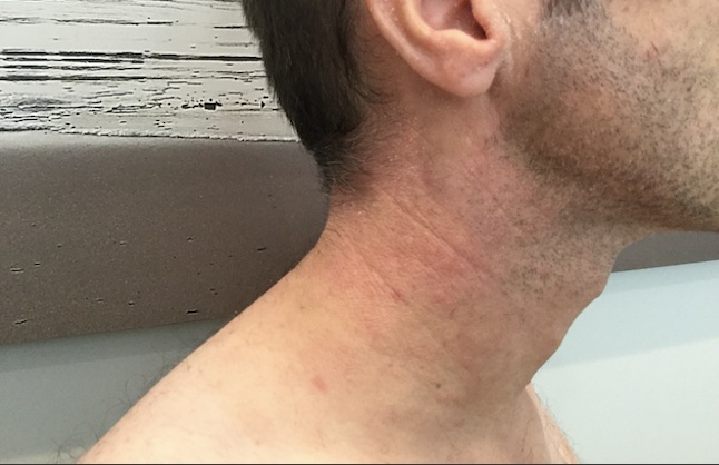 Psoriasis traitement naturel efficace